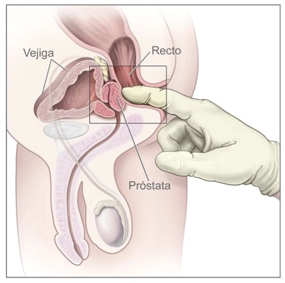 chequeo prostata urologo